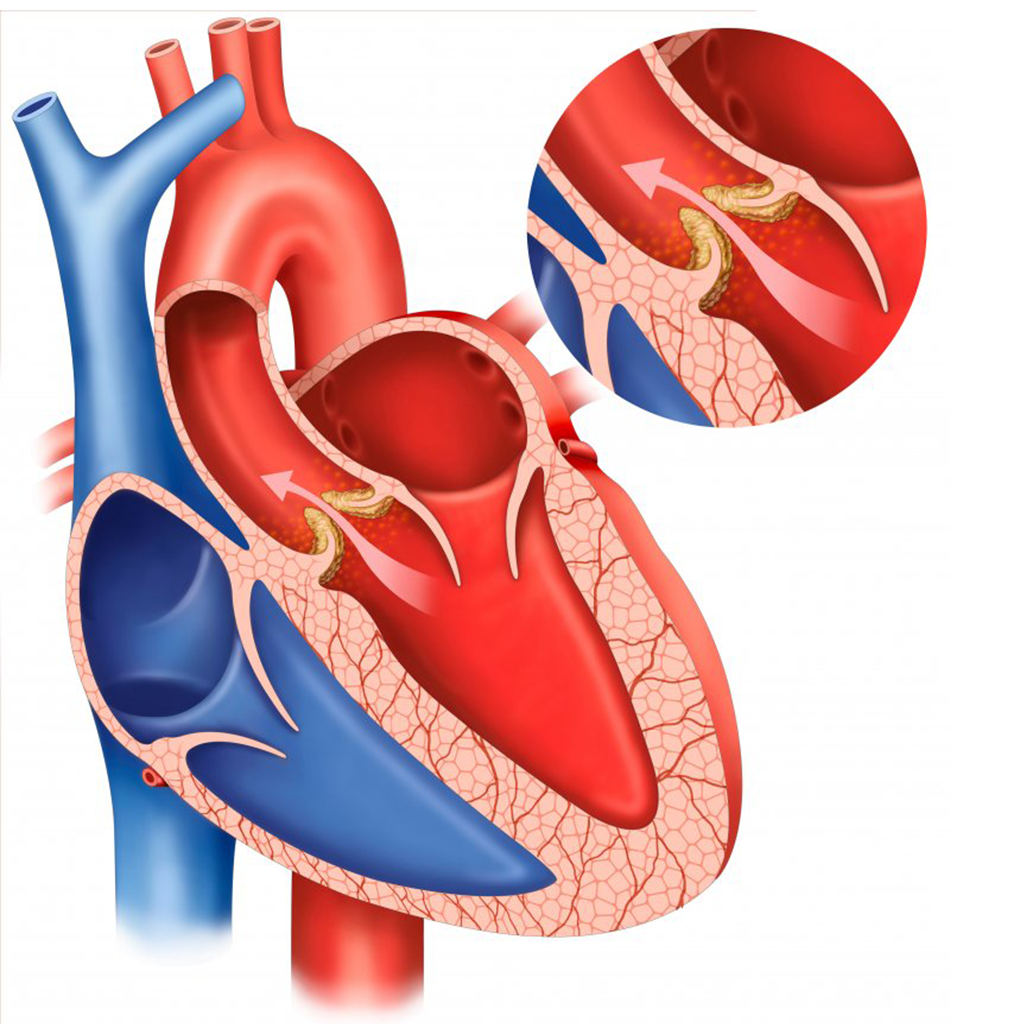 La sténose de la valve aortique : symptômes, causes et traitement - GSD -  un groupe de cliniques en Italie