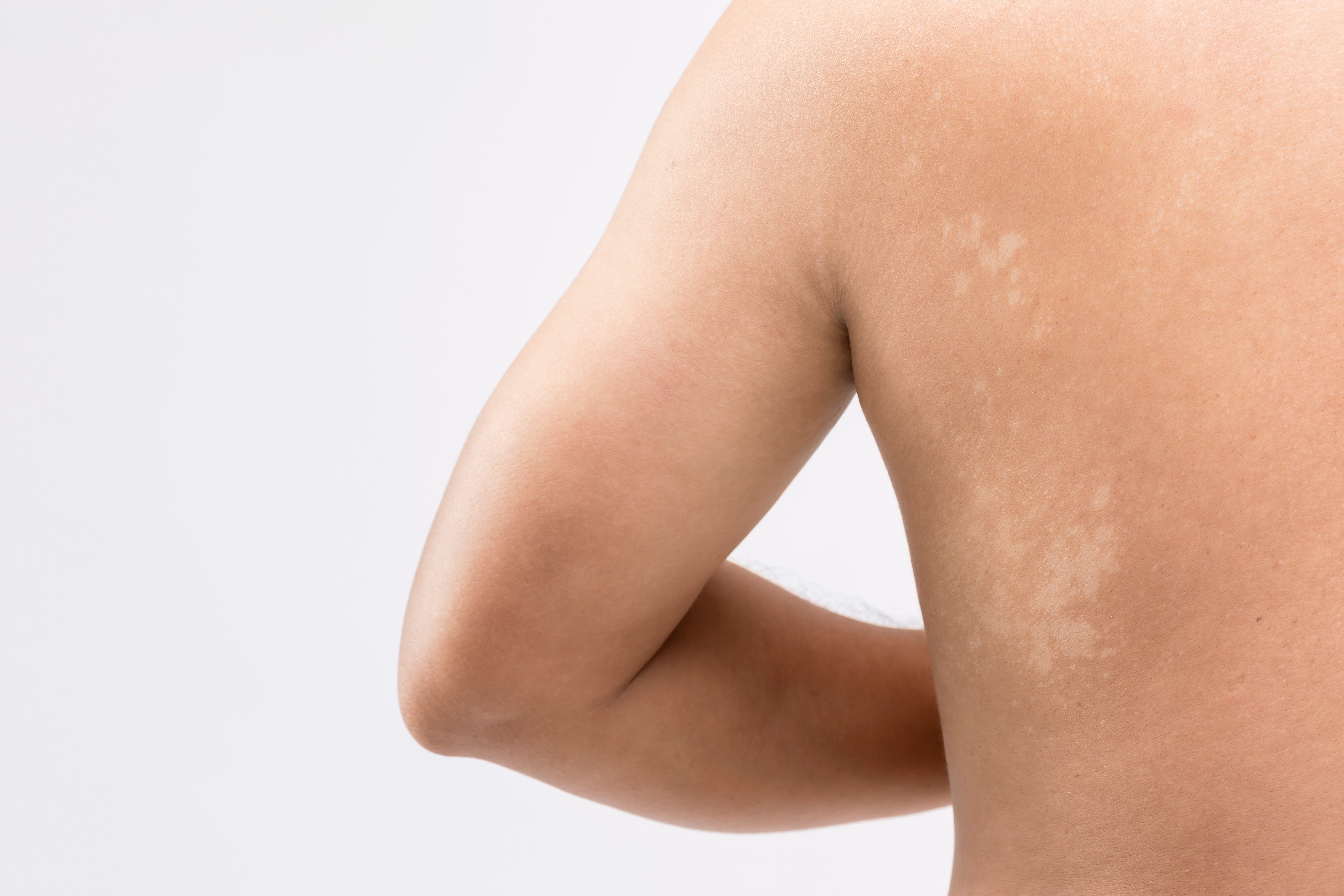 Quelles sont les causes des taches blanches sur la peau ? - GSD ...