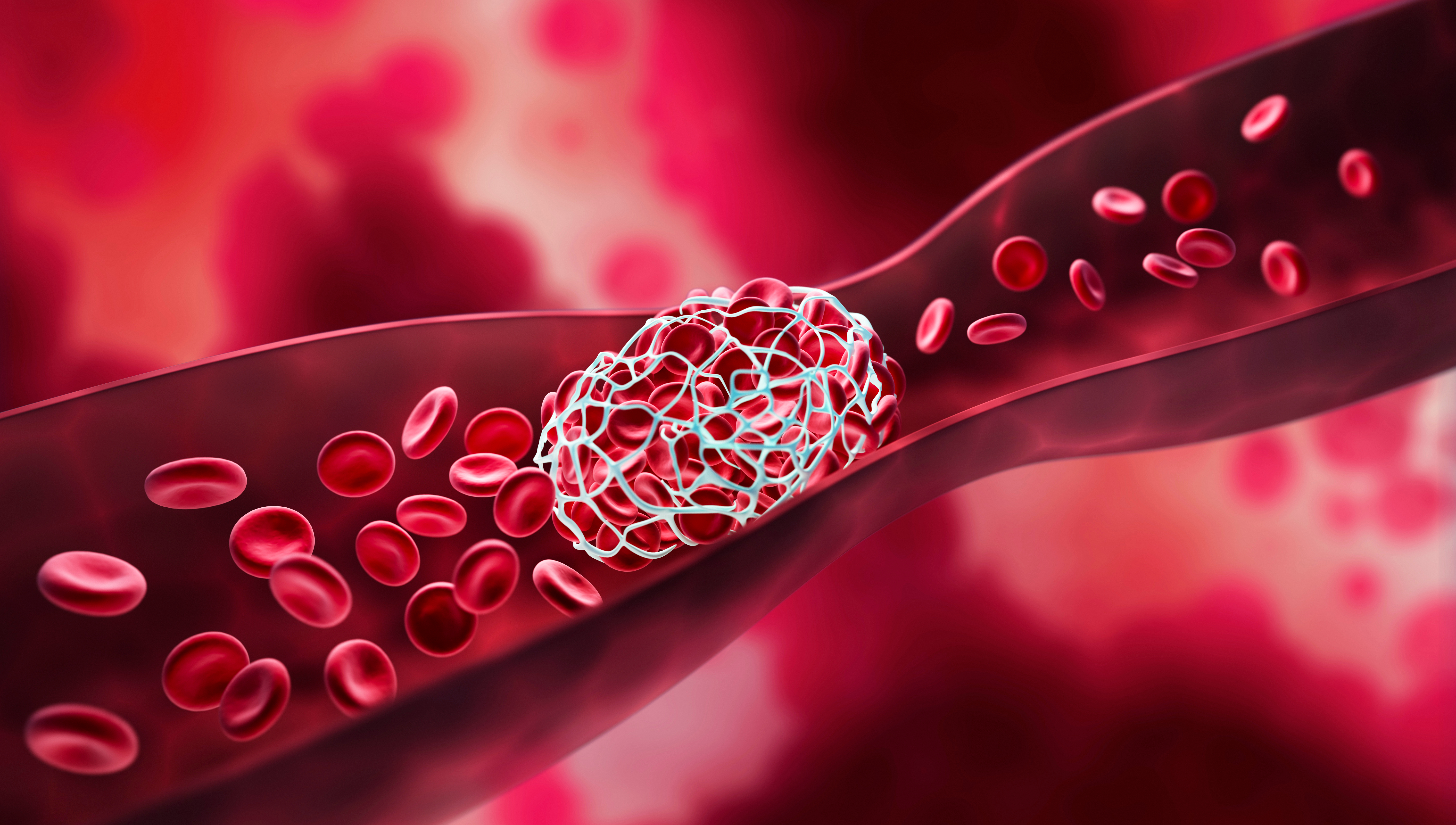 New study on the link between venous thrombosis and cancer
