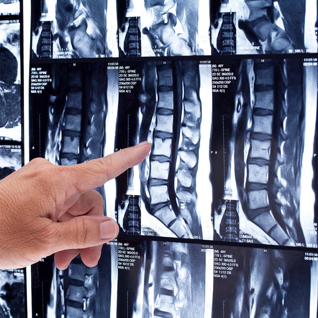 Грыжа в поясничном отделе корешок 5. Мрт при радикулите. Межпозвонковая грыжа крестцового отдела. Междисковая грыжа позвоночника. Рецидив грыжи позвоночника.